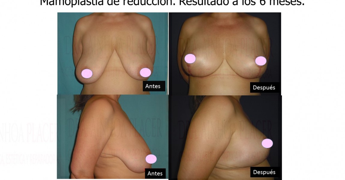 clínica de cirugía estética en Madrid Todo lo que necesitas saber sobre la mamoplastia de reducción