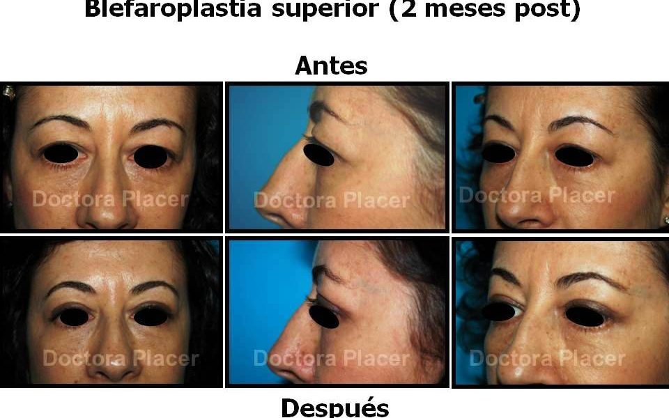 clínica de cirugía estética en Madrid Blefaroplastia: cirugía de los párpados para rejuvenecer su mirada.