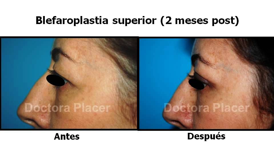 blefaroplastia-superior-perfil