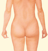 ejemplo de liposucción de abdomen y flancos