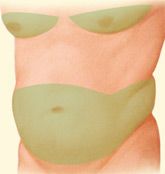 ejemplo de liposucción de abdomen y flancos