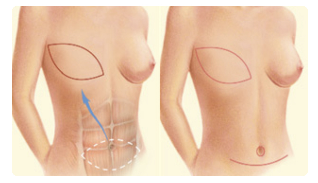Primera reconstrucción mamaria microquirúrgica realizada en Ibiza. Reconstrucción mamaria tras Cáncer de mama.
